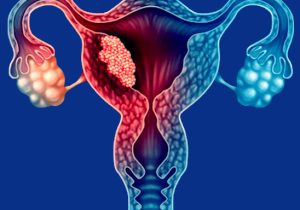 Fibroid Fibroid