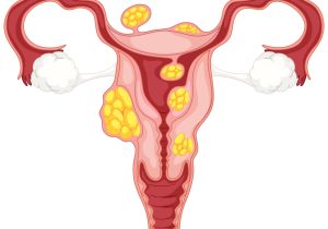 Diagram of subserosal uterine fibroids illustration